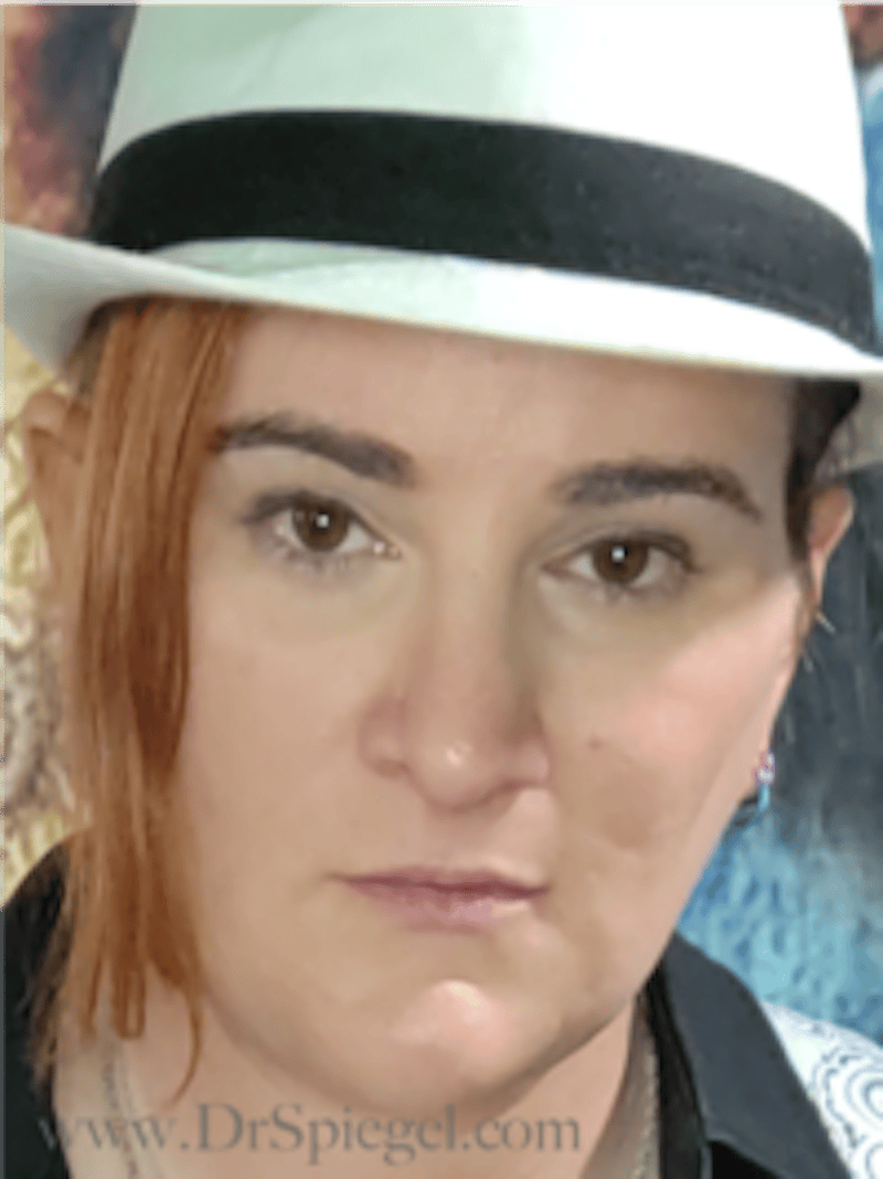 FFS Before & After Gallery - Patient 235658 - Image 4