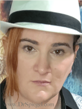 FFS Before & After Gallery - Patient 235658 - Image 4