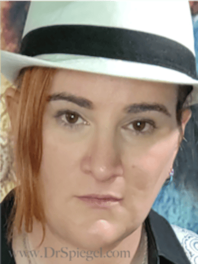 FFS Before & After Gallery - Patient 235658 - Image 4