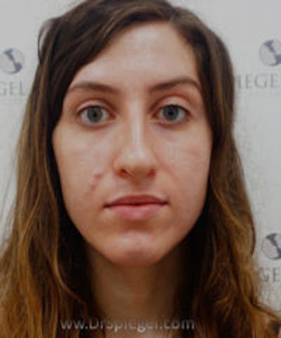 FFS Before & After Gallery - Patient 203481 - Image 1