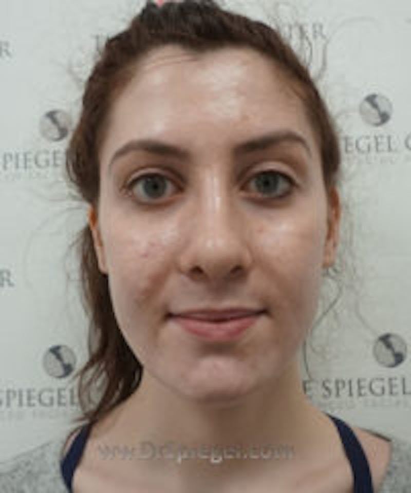 FFS Before & After Gallery - Patient 203481 - Image 2