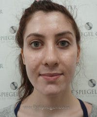 FFS Before & After Gallery - Patient 203481 - Image 2