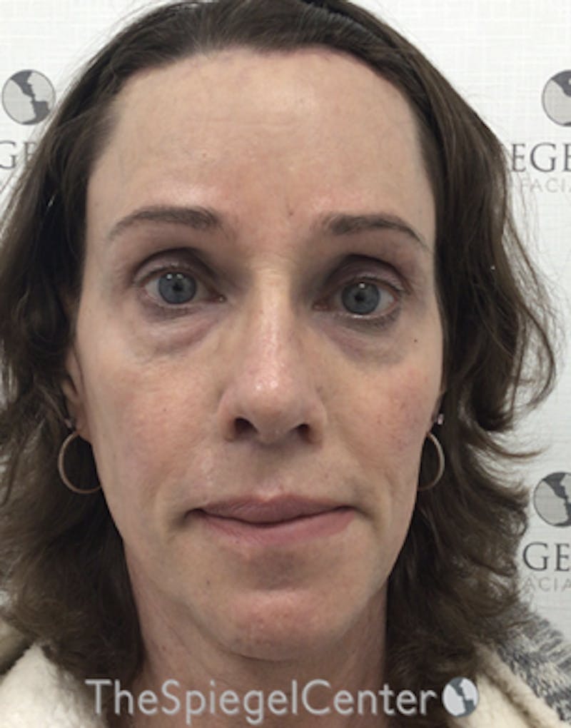 FFS Before & After Gallery - Patient 271663 - Image 2