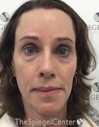 FFS Before & After Gallery - Patient 271663 - Image 2