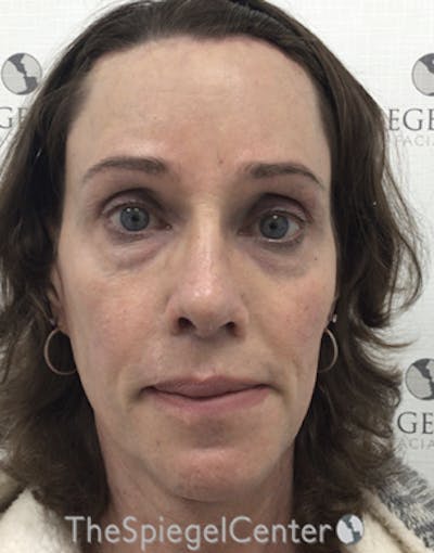 FFS Before & After Gallery - Patient 271663 - Image 2