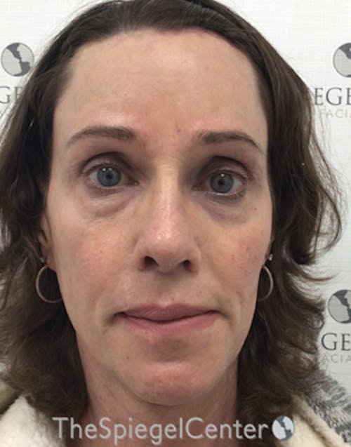 FFS Before & After Gallery - Patient 271663 - Image 2