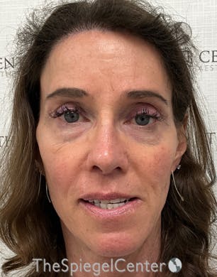 FFS Before & After Gallery - Patient 271663 - Image 4