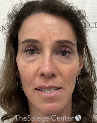 FFS Before & After Gallery - Patient 271663 - Image 4