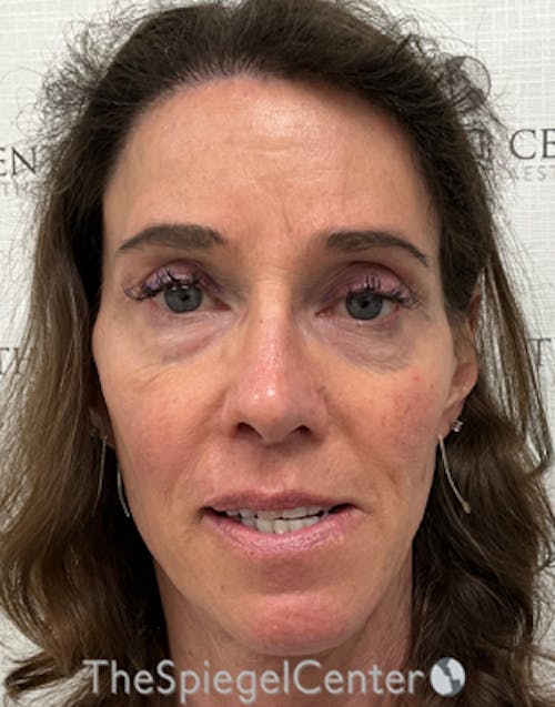 FFS Before & After Gallery - Patient 271663 - Image 4