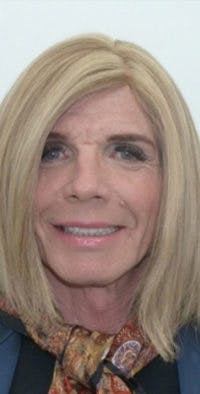 FFS Before & After Gallery - Patient 983359 - Image 1