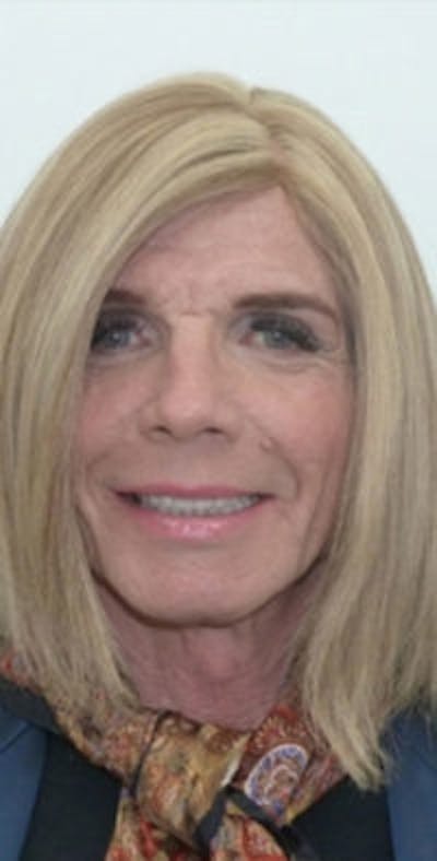 FFS Before & After Gallery - Patient 983359 - Image 1