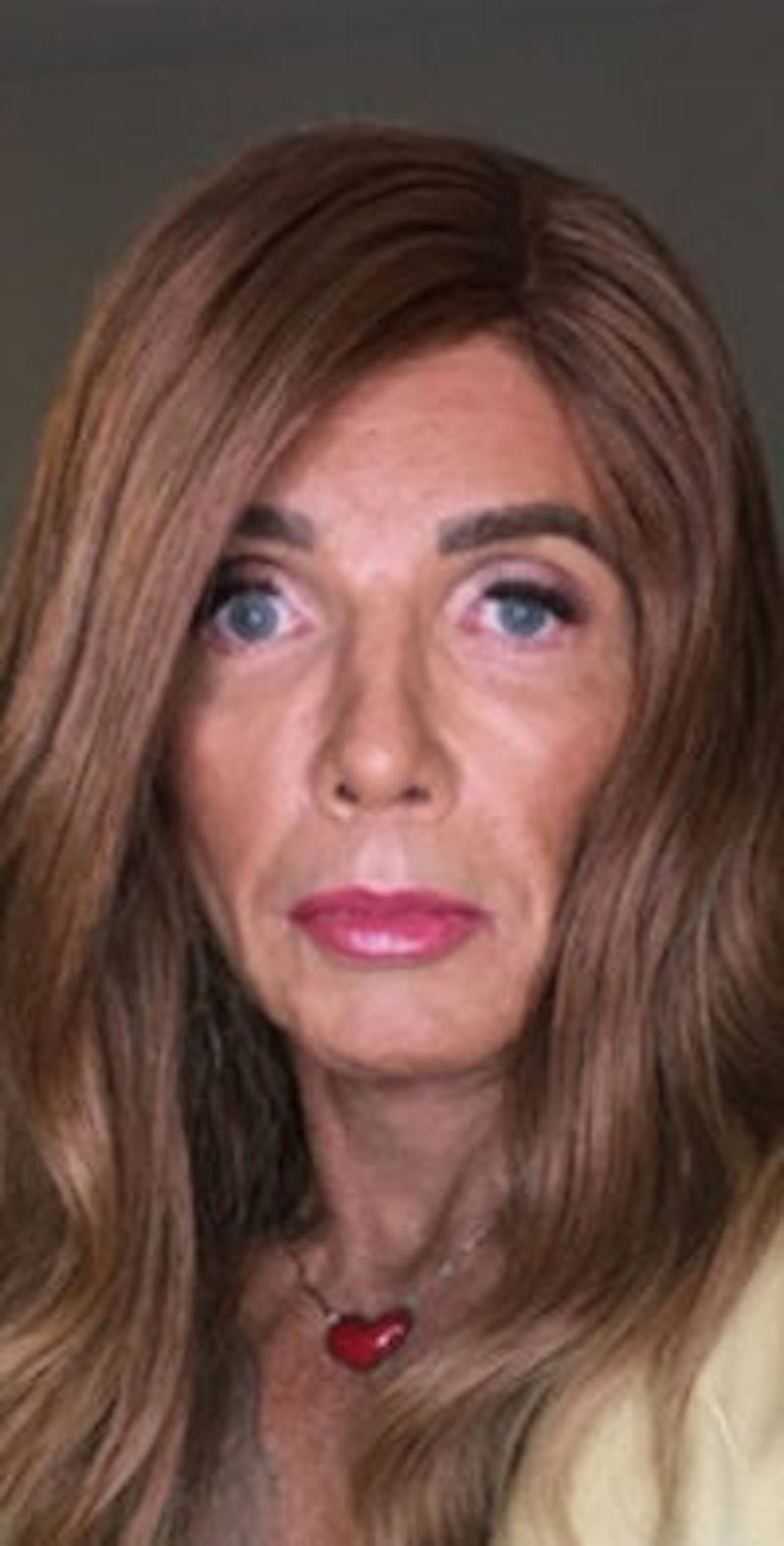 FFS Before & After Gallery - Patient 983359 - Image 2