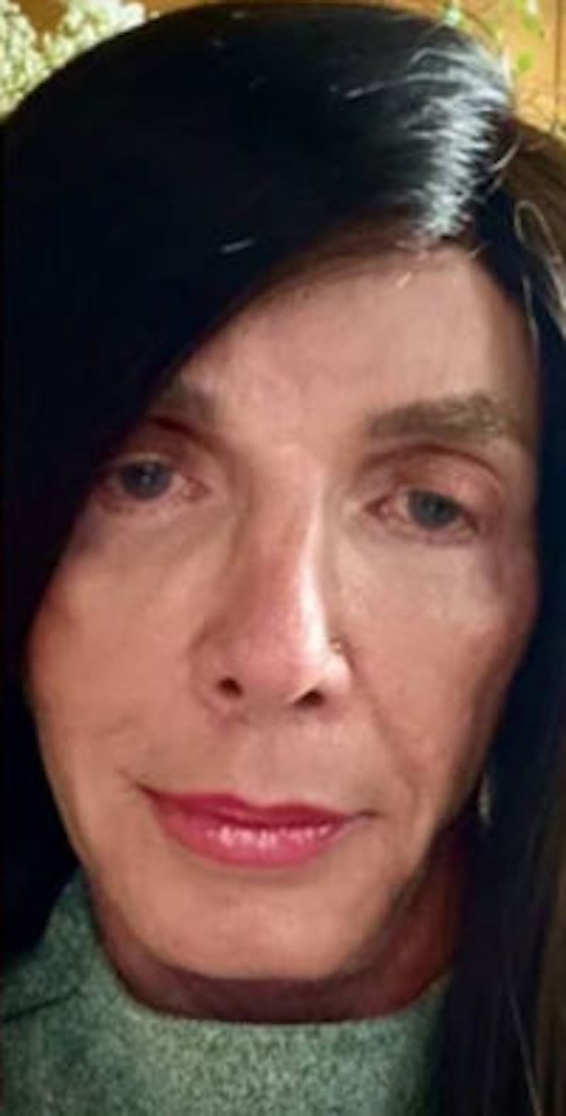 FFS Before & After Gallery - Patient 983359 - Image 3