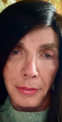 FFS Before & After Gallery - Patient 983359 - Image 3