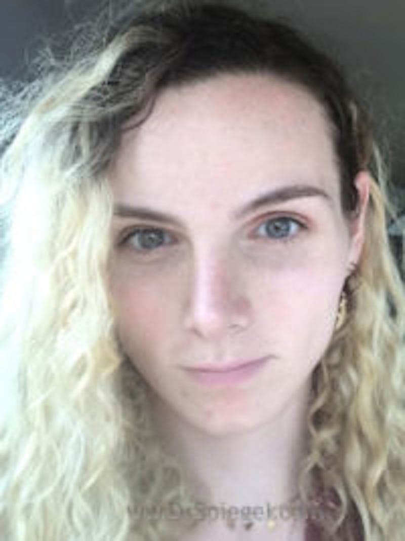 FFS Before & After Gallery - Patient 173668 - Image 4