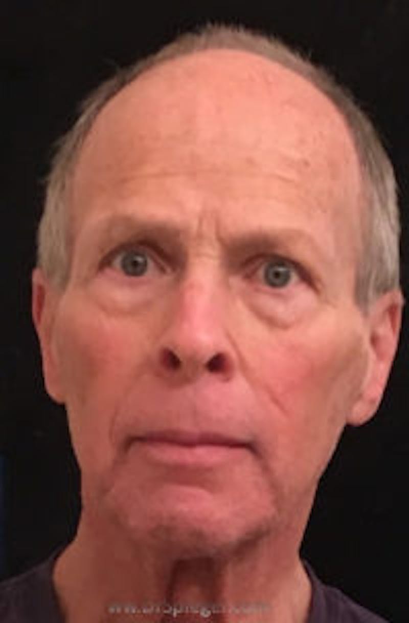 FFS Before & After Gallery - Patient 423578 - Image 1