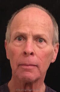FFS Before & After Gallery - Patient 423578 - Image 1