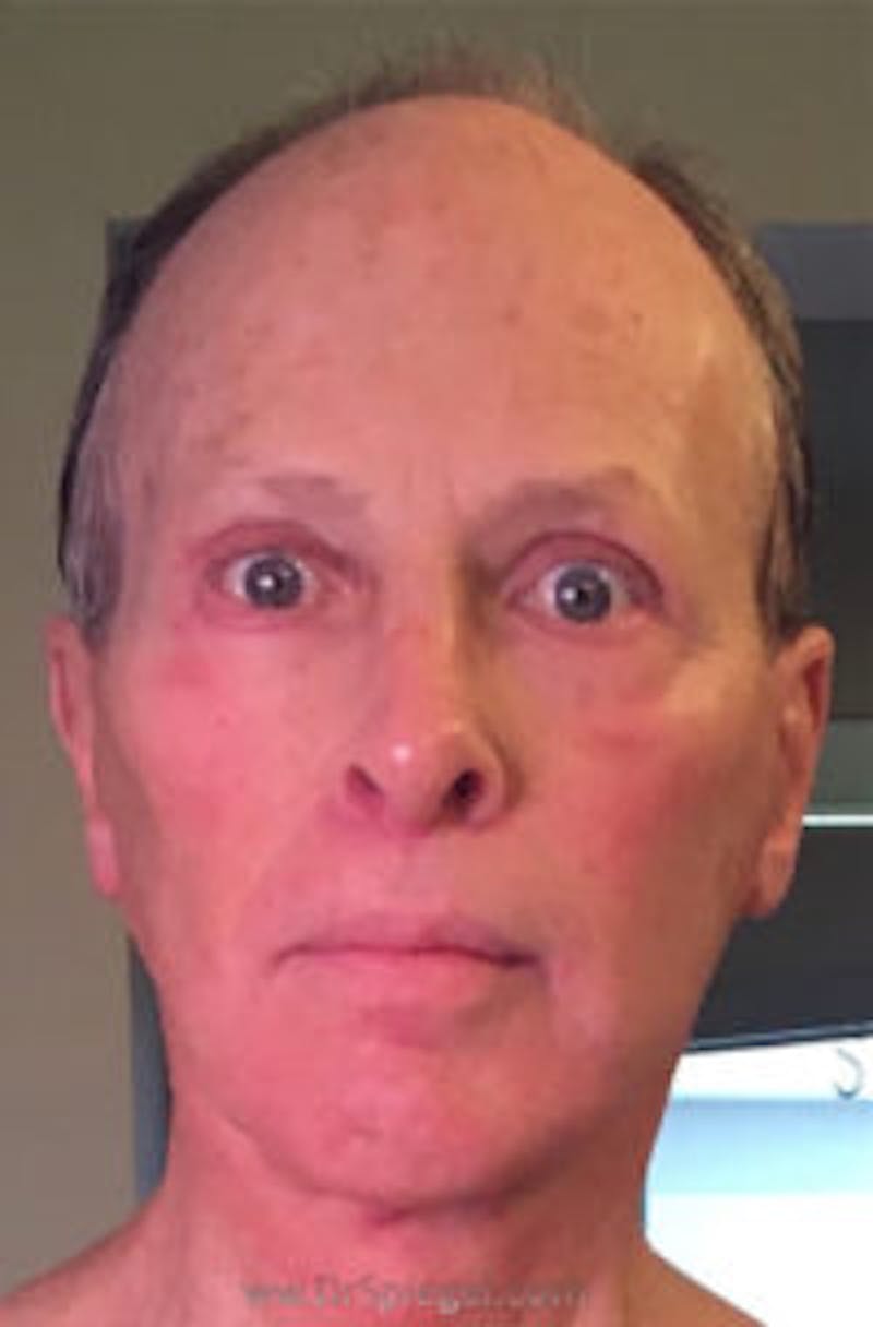 FFS Before & After Gallery - Patient 423578 - Image 2