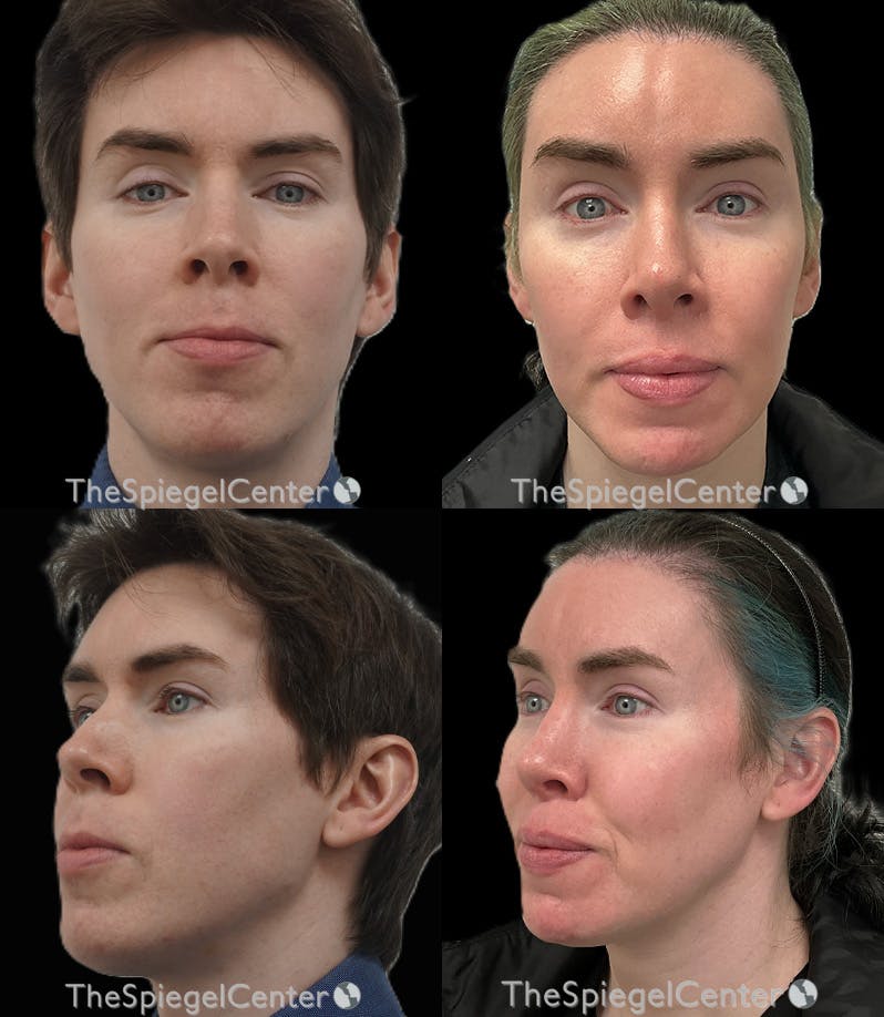 FFS Before & After Gallery - Patient 193937 - Image 1