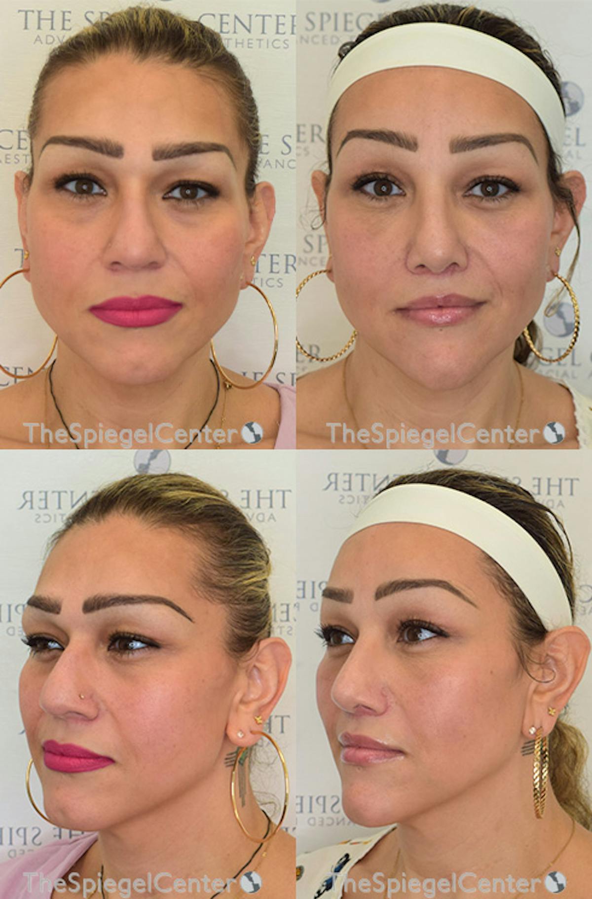 FFS Before & After Gallery - Patient 368602 - Image 1