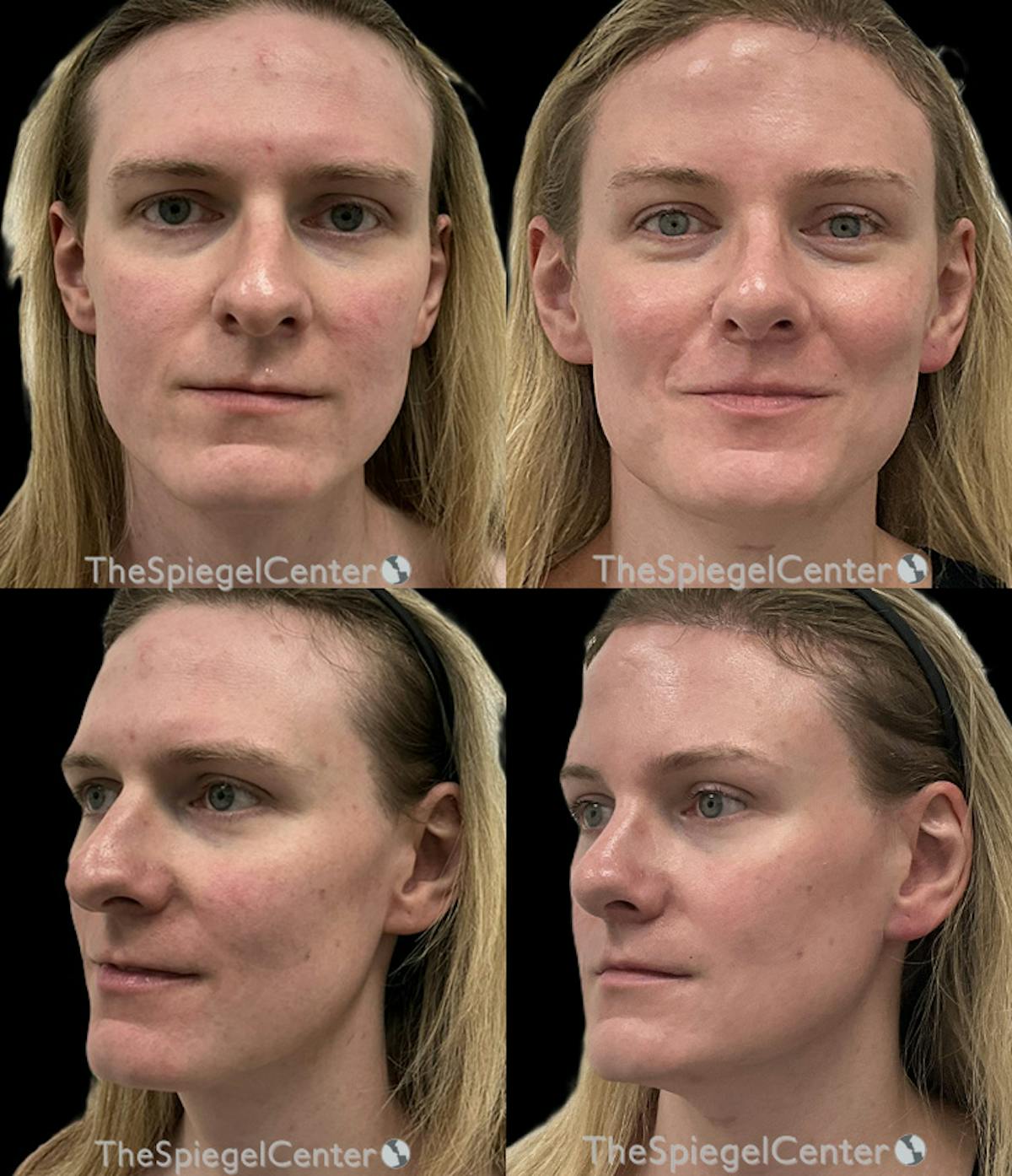 FFS Before & After Gallery - Patient 388797 - Image 1