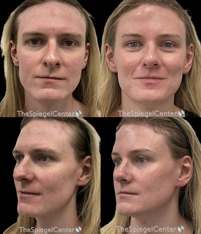 FFS Before & After Gallery - Patient 388797 - Image 1