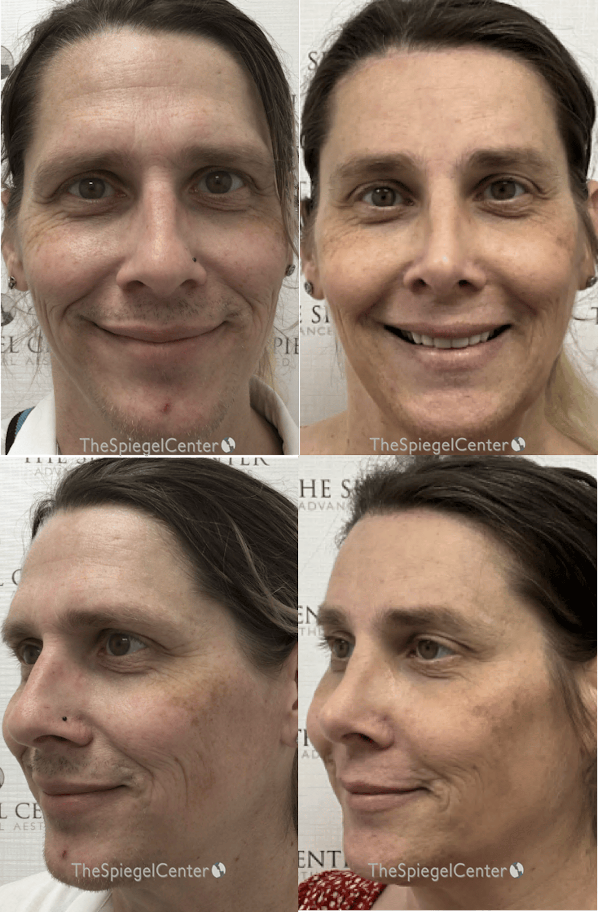 FFS Before & After Gallery - Patient 178845 - Image 1