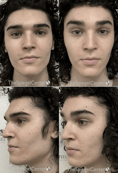 FFS Before & After Gallery - Patient 164520 - Image 1