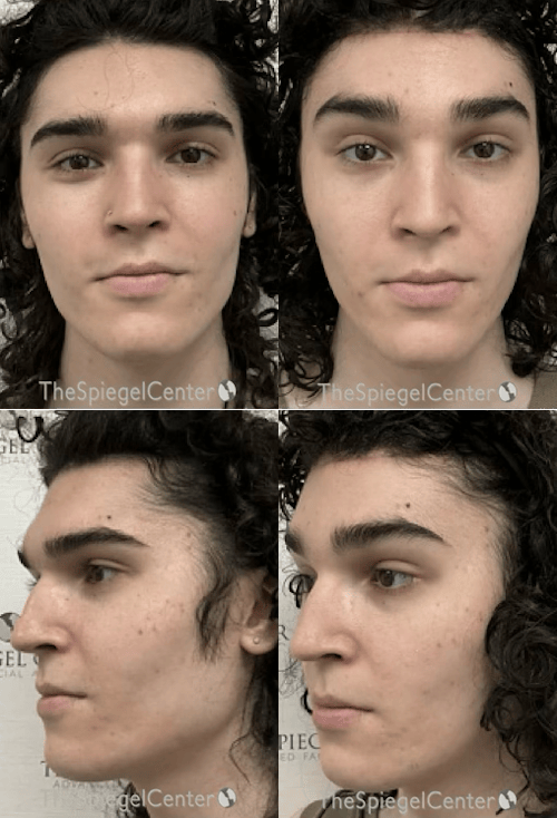 FFS Before & After Gallery - Patient 164520 - Image 1