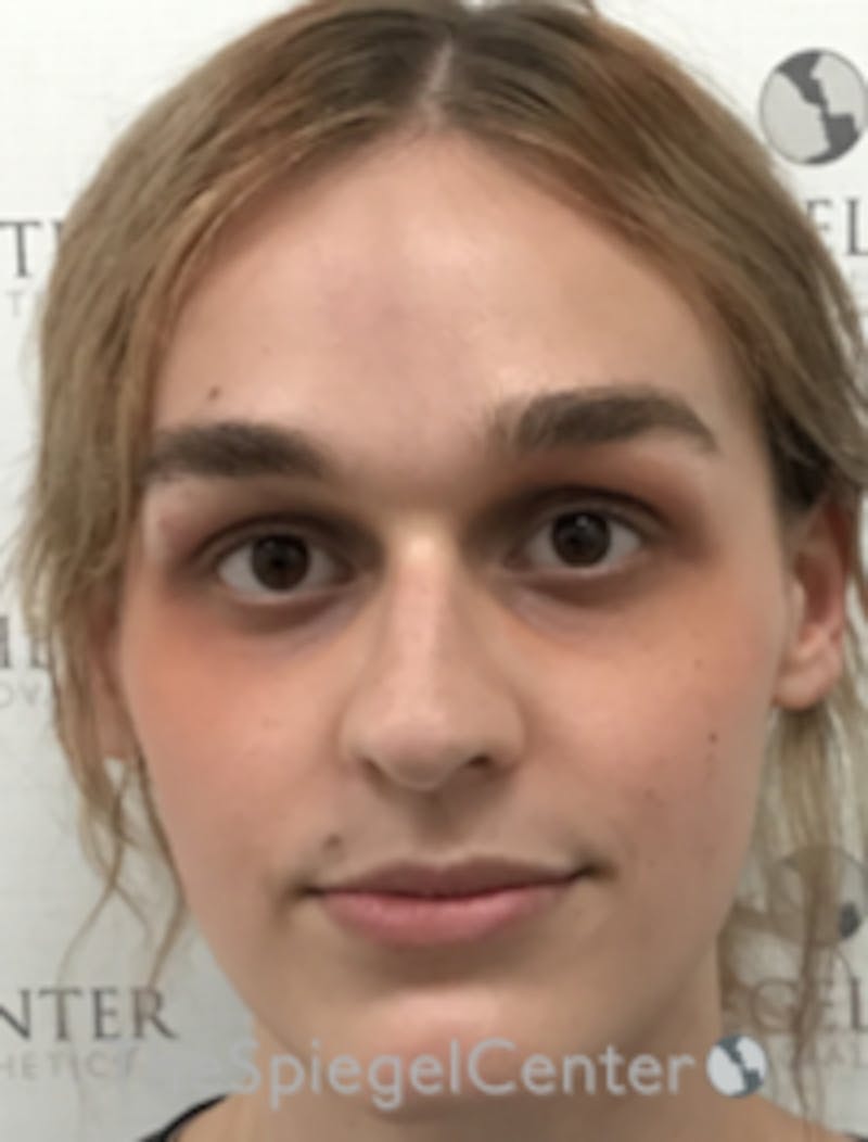 FFS Before & After Gallery - Patient 281675 - Image 1