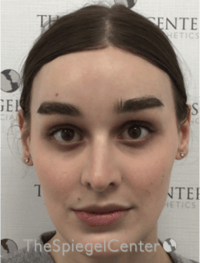 FFS Before & After Gallery - Patient 281675 - Image 2
