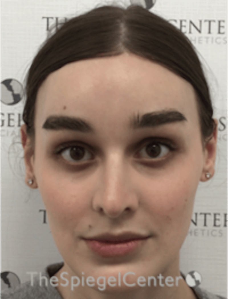 FFS Before & After Gallery - Patient 281675 - Image 2