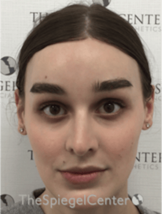 FFS Before & After Gallery - Patient 281675 - Image 2