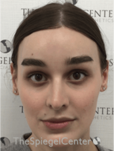 FFS Before & After Gallery - Patient 281675 - Image 2