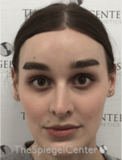 FFS Before & After Gallery - Patient 281675 - Image 2