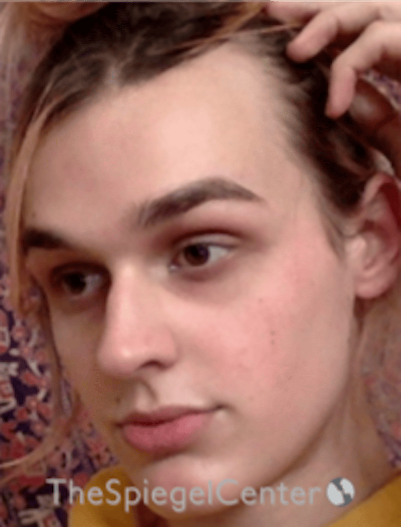 FFS Before & After Gallery - Patient 281675 - Image 3