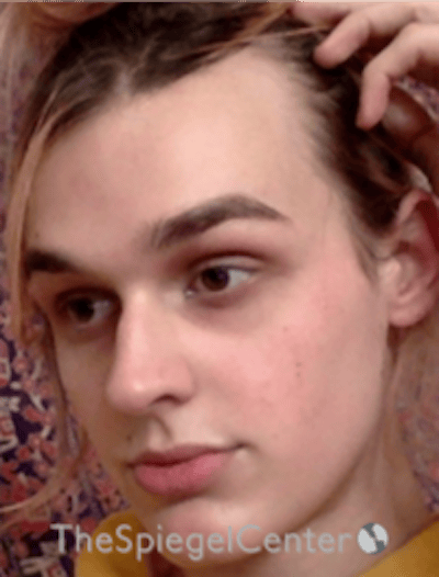 FFS Before & After Gallery - Patient 281675 - Image 3