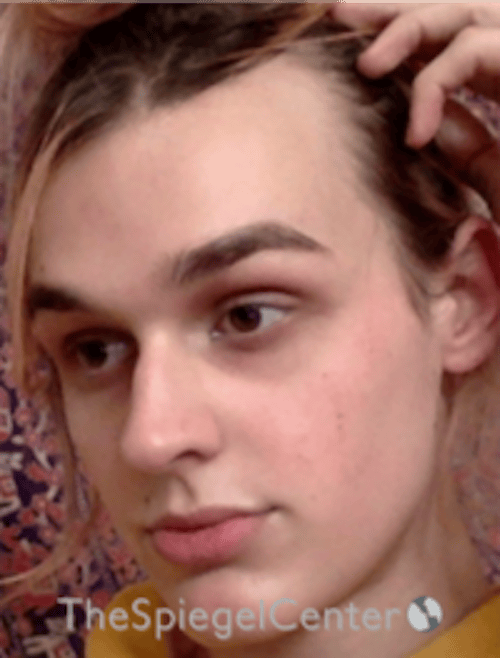 FFS Before & After Gallery - Patient 281675 - Image 3