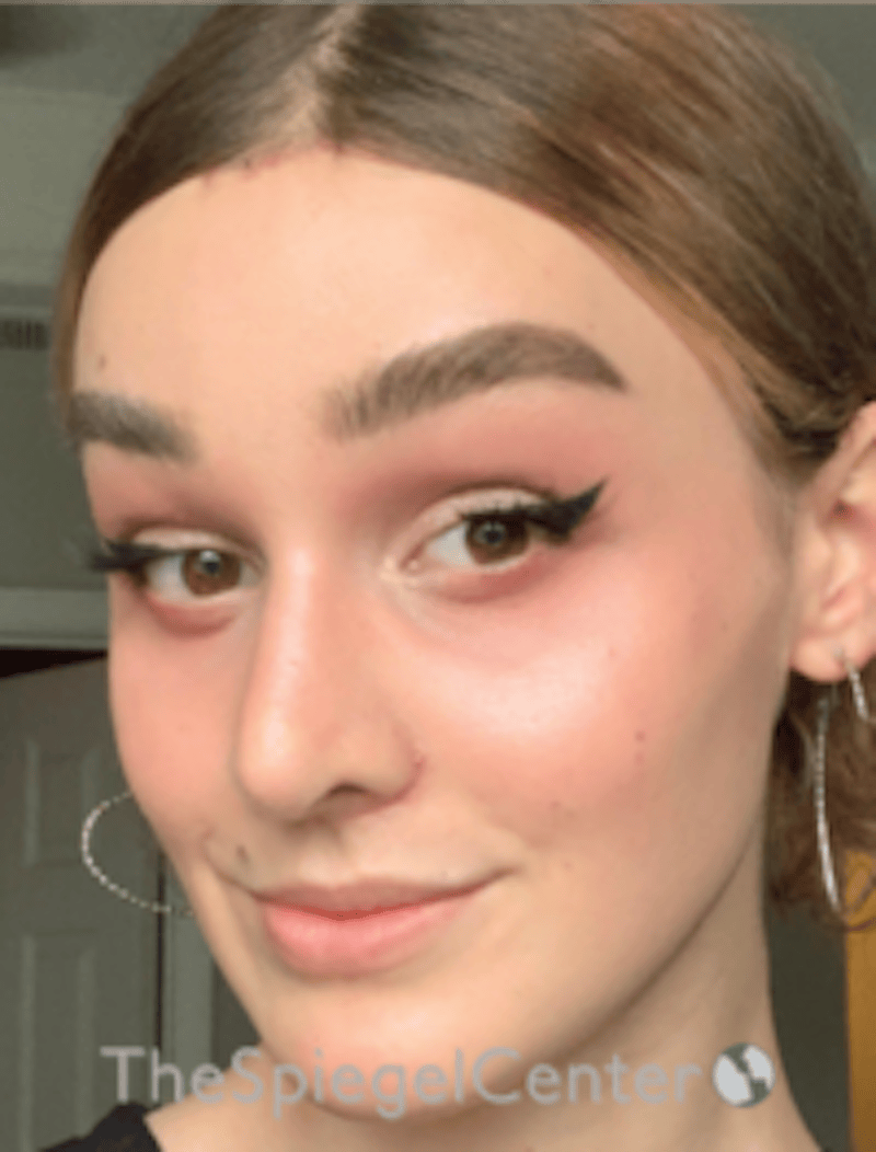 FFS Before & After Gallery - Patient 281675 - Image 4