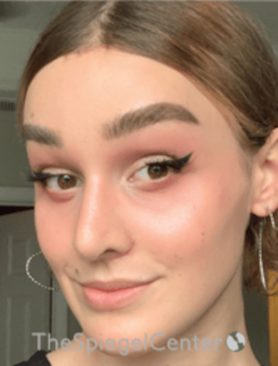 FFS Before & After Gallery - Patient 281675 - Image 4