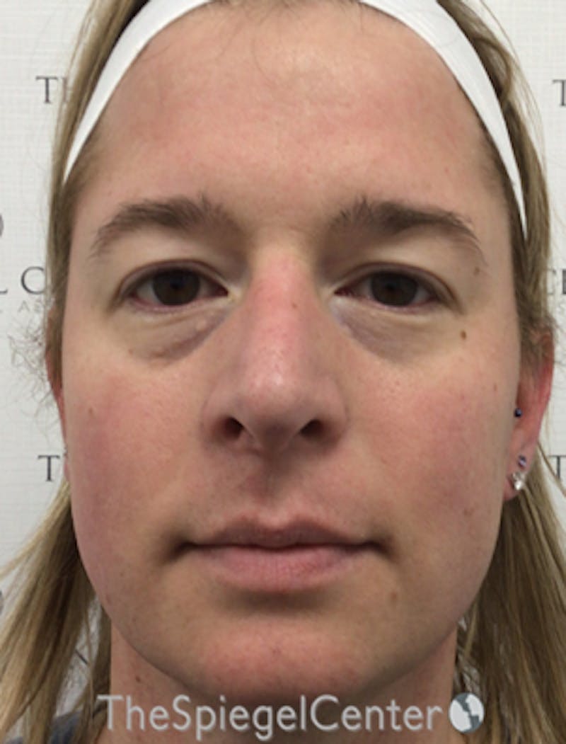 FFS Before & After Gallery - Patient 259188 - Image 1