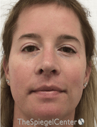 FFS Before & After Gallery - Patient 259188 - Image 2