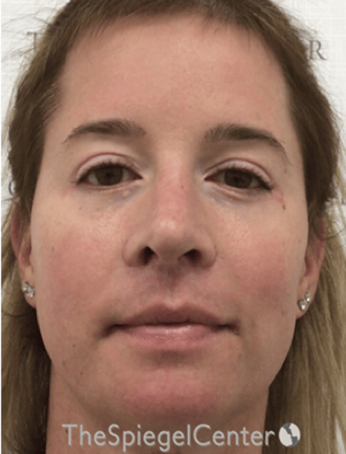 FFS Before & After Gallery - Patient 259188 - Image 2