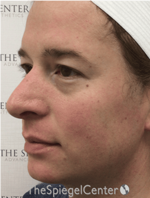 FFS Before & After Gallery - Patient 259188 - Image 3