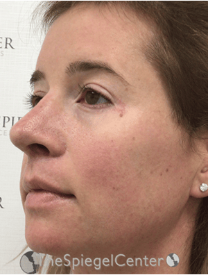 FFS Before & After Gallery - Patient 259188 - Image 4