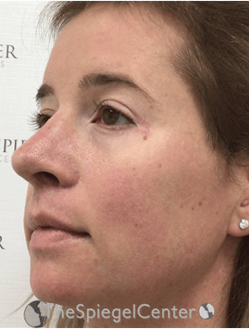 FFS Before & After Gallery - Patient 259188 - Image 4