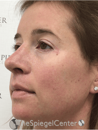 FFS Before & After Gallery - Patient 259188 - Image 4