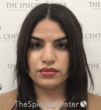 FFS Before & After Gallery - Patient 502303 - Image 1