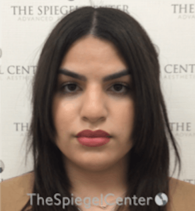 FFS Before & After Gallery - Patient 502303 - Image 1