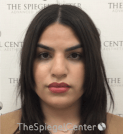 FFS Before & After Gallery - Patient 502303 - Image 1
